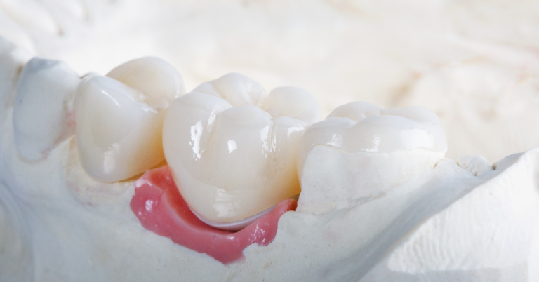 Are Dental Crowns Necessary?