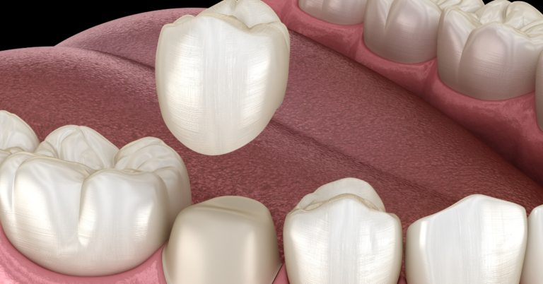 Are Dental Crowns Permanent?
