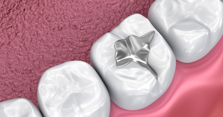 Are Dental Fillings Permanent?