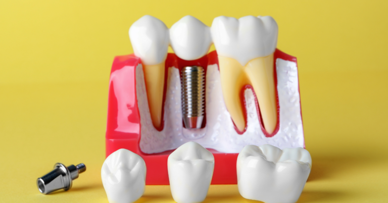 Are Dental Implants Better Than Crowns?