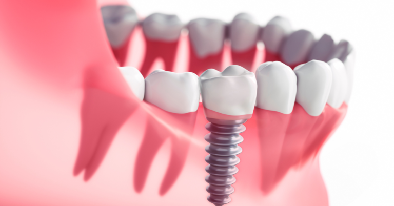 Are Dental Implants Permanent?