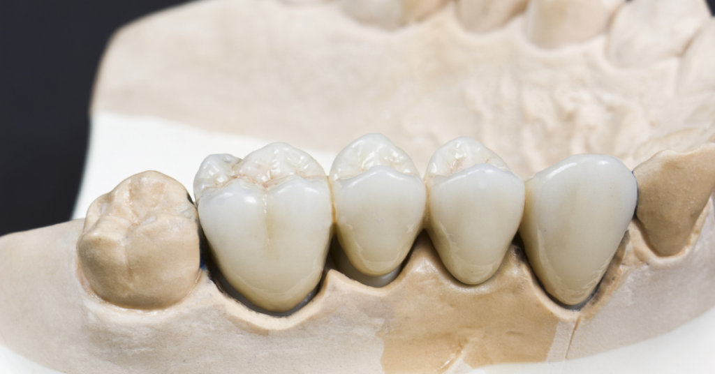 Can a dental bridge be removed and recemented? Perfect Dental Can a dental bridge be removed and recemented? Perfect Dental
