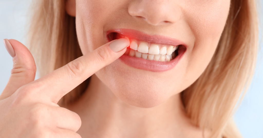 Do Gums Bleed During Scaling And Root Planing? Perfect Dental