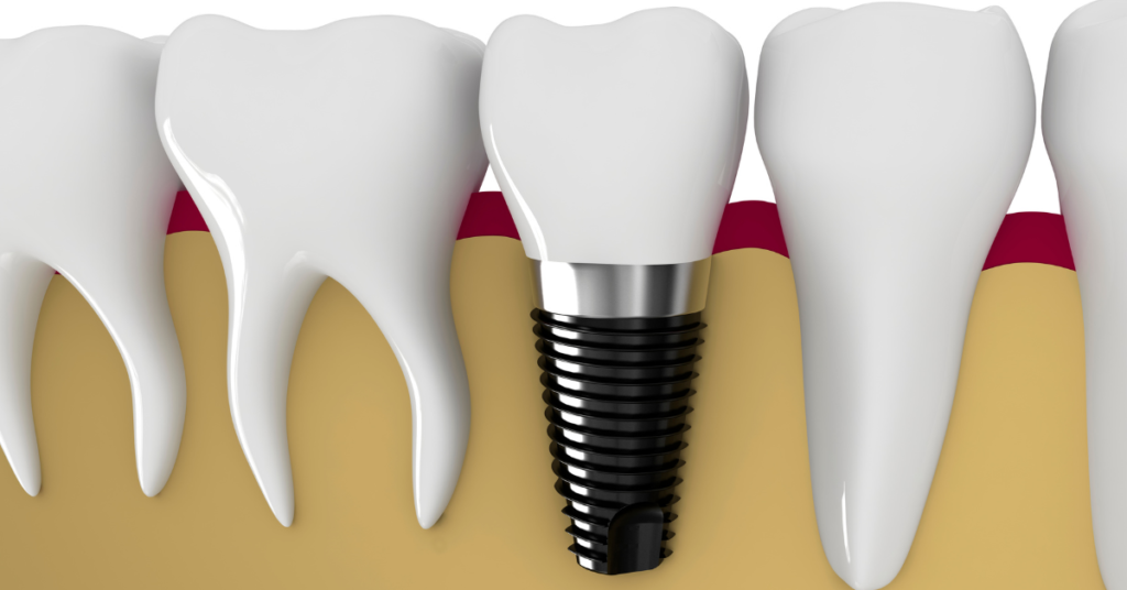 How long does a dental implant procedure take? Perfect Dental