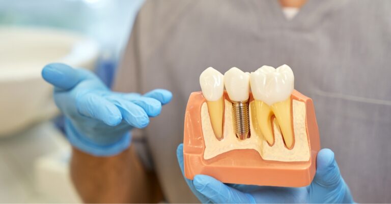 What Is A Dental Implant?