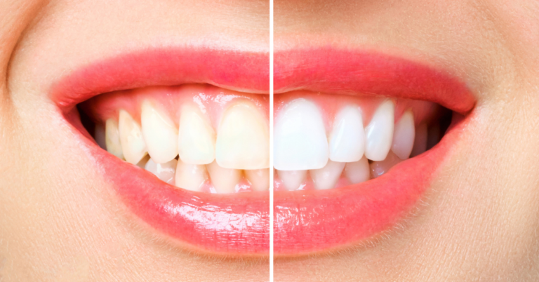 What To Eat After Teeth Whitening?